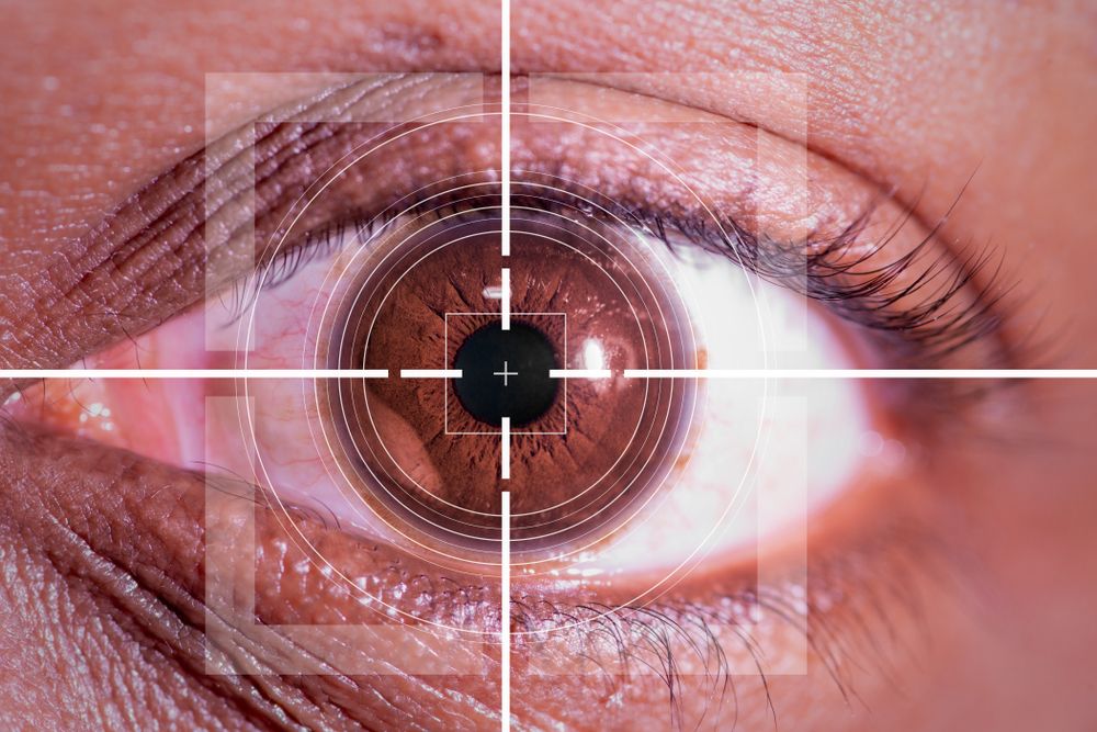 The Link Between LASIK Surgery and Ectasia: What You Should Know