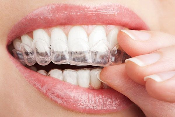 Invisalign