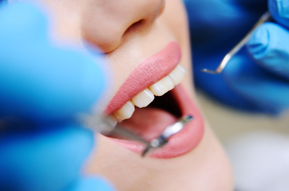 5 Reasons for Emergency Tooth Extraction