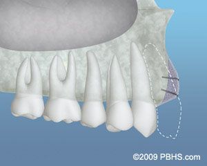 Before Bone Graft 2