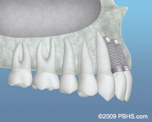 Before Bone Graft 3