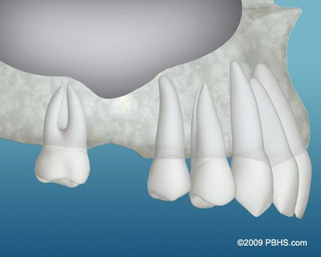 Bone Graft Inadequate Bone