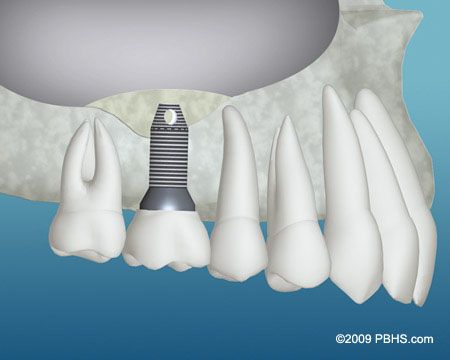 Bone Graft - Graft Material and Implant Placed