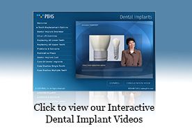 dental implant presentation