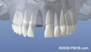 Implant Placement - Tooth Loss