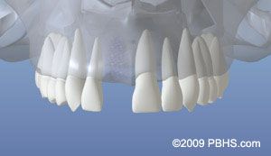 Implant Placement - Healed Bone