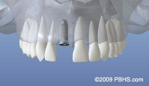 Implant Placement - Healed Bone