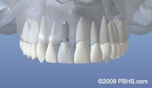 Implant Placement - Implant Placed