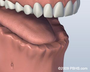 Before Bar Attachment Denture 1