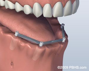 Before Bar Attachment Denture 2