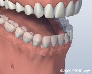 Before Bar Attachment Denture 3