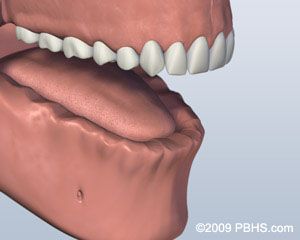 Before Ball Attachment Denture 1