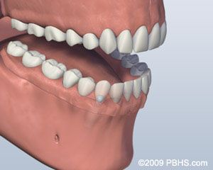 Before Ball Attachment Denture 3