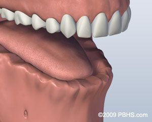 Before Screw Retained Denture 1