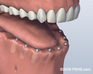 Before Screw Retained Denture 2