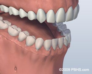 Before Screw Retained Denture 3