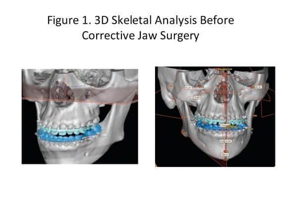 Jaw Surgery