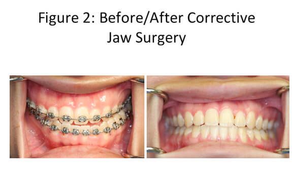 Jaw Surgery Before and After