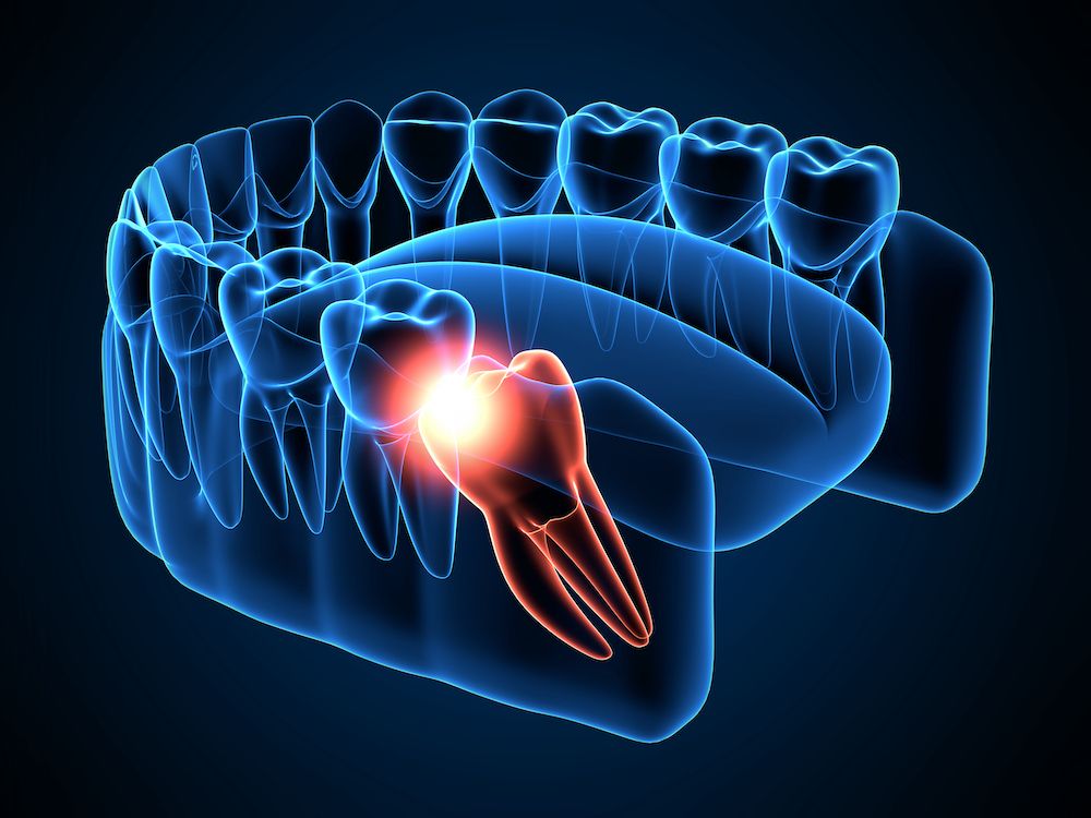 Why Wisdom Teeth Should Be Removed