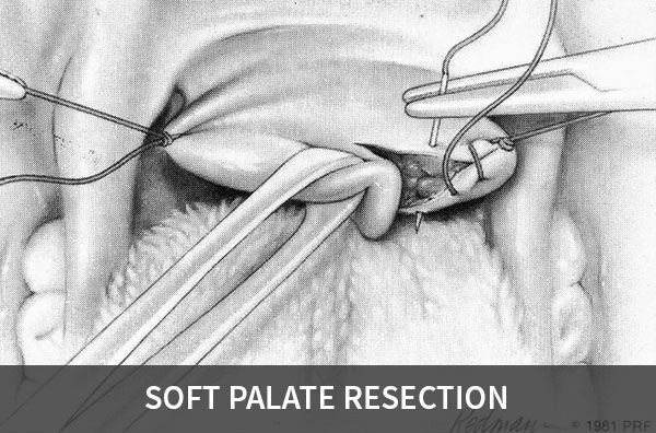 soft palate resection
