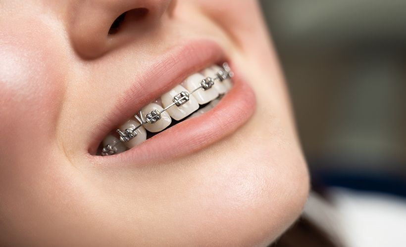 Got Braces?  Family dentistry, Teeth braces, Dentistry