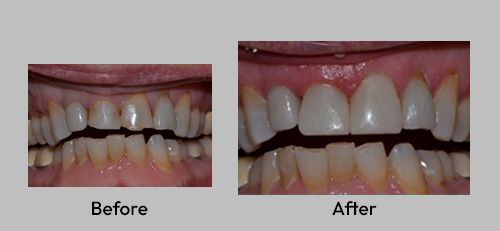 dental bonding before and after