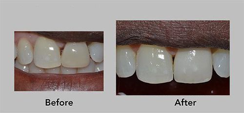 dental bonding results