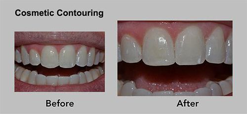 Cosmetic Contouring