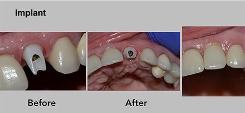 dental ​​​​​​​Implants