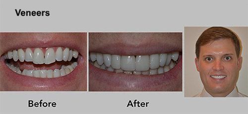 teeth Veneers