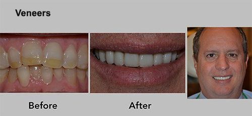 Veneers results