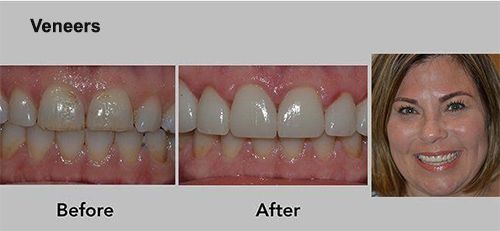 dental Veneers