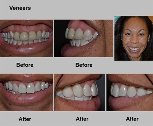 woman with Veneers