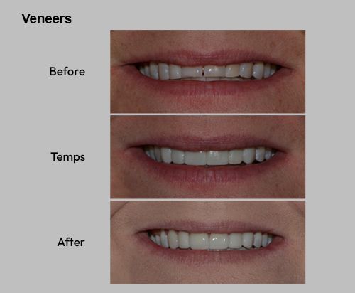 Veneers amazing results