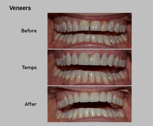 Veneers transition