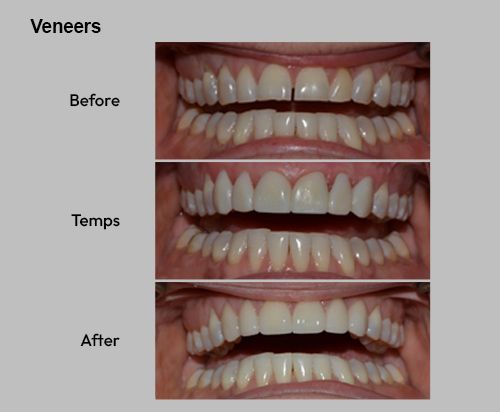 Veneers transition