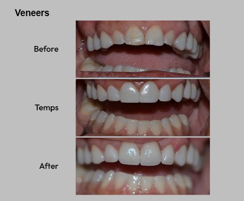 Veneers 3