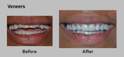 Veneers