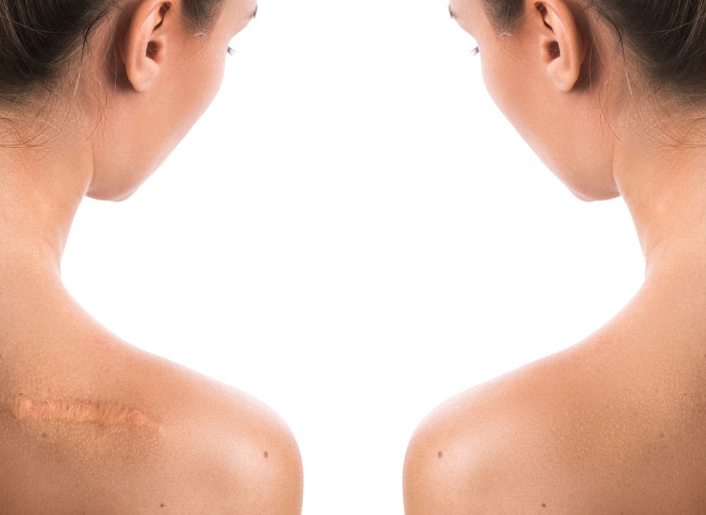 How Scar Revision Can Improve the Appearance of Your Skin