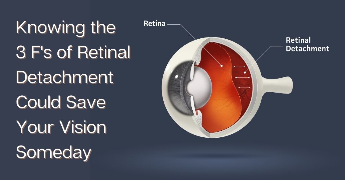 Know the 3 F's of Retinal Detachments