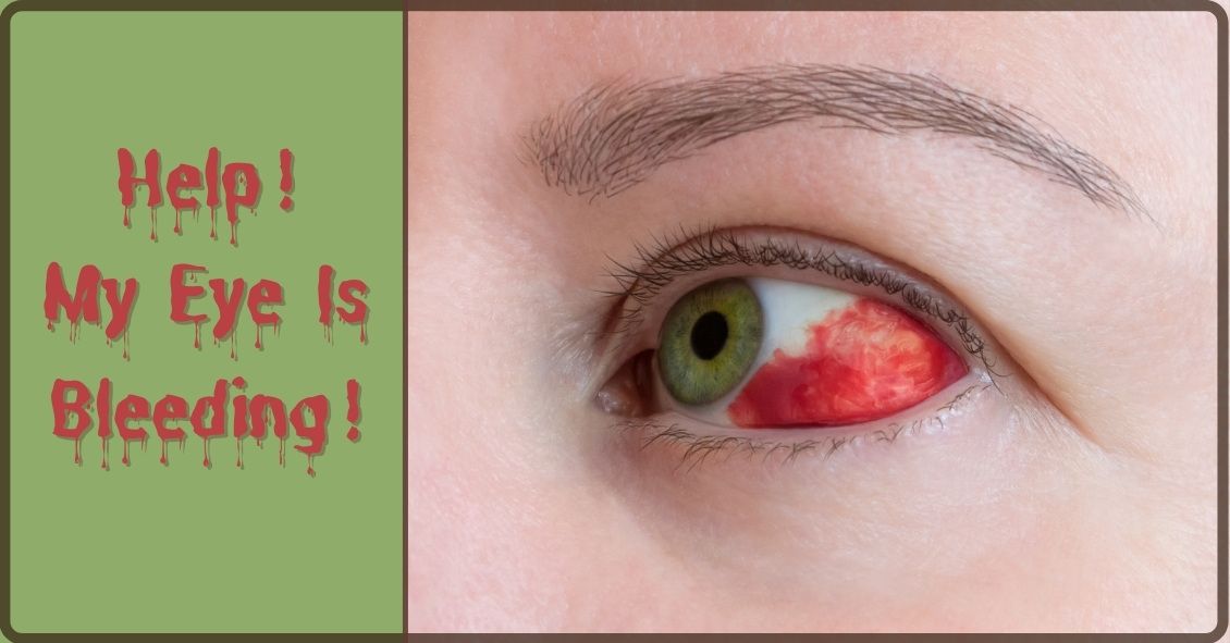 Help! Is My Eye Bleeding?
