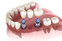 Teeth Whitening