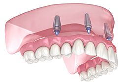 Teeth Whitening