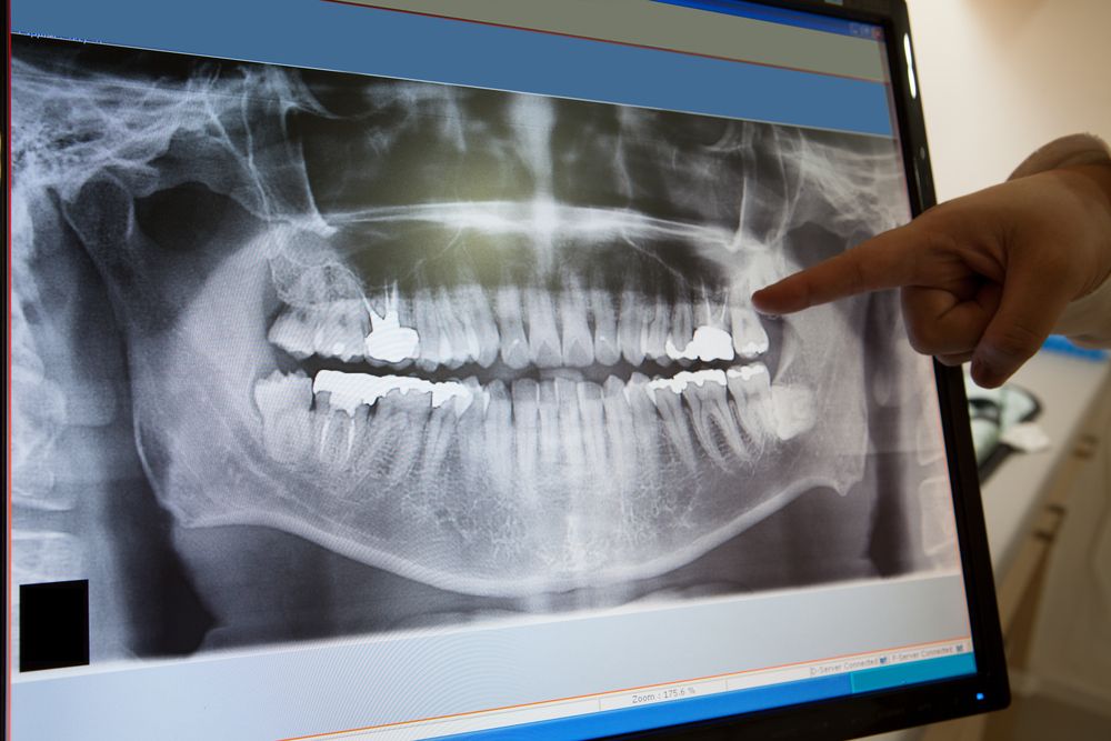 How Safe Are Dental X-Rays?