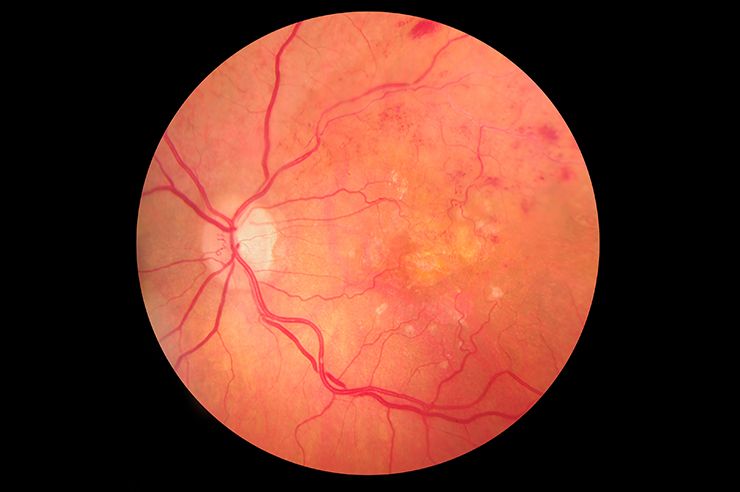 Centervue® - DRSplus Retinal Imaging 