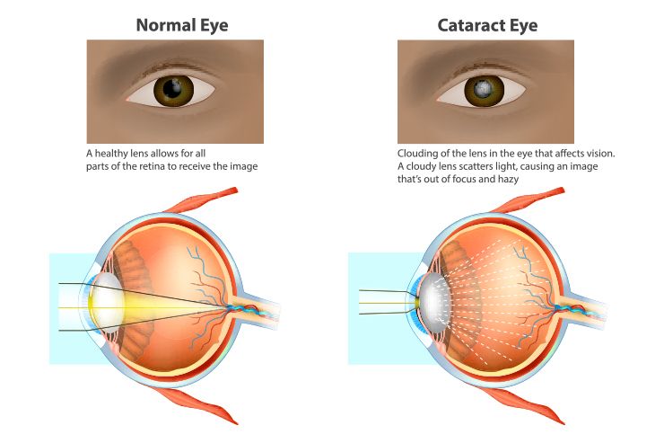 Cataracts. So, what are those again…?