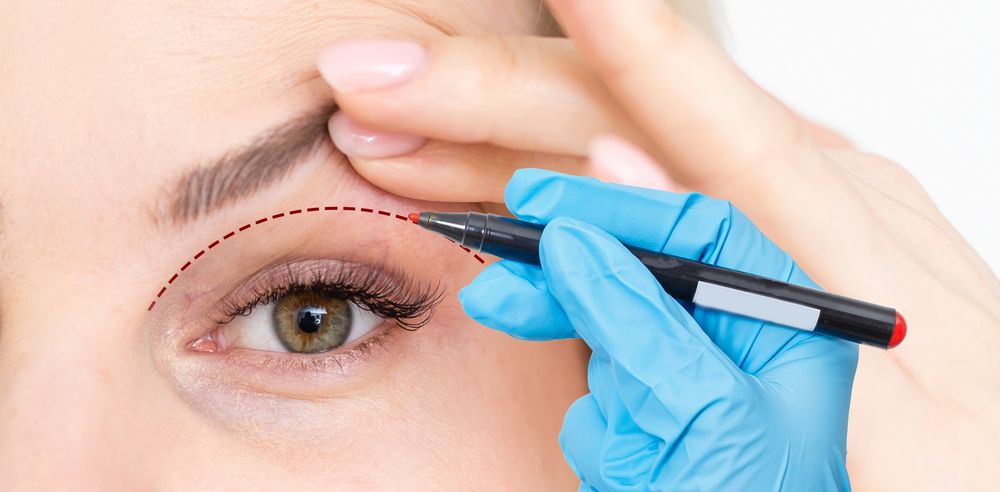 Lifting the Veil: The Aesthetic Marvels of Eyelid Surgery