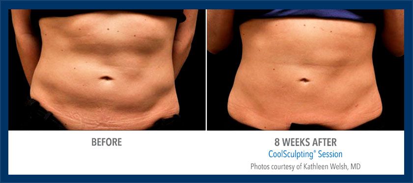 CoolSculpting - Plastic Surgery