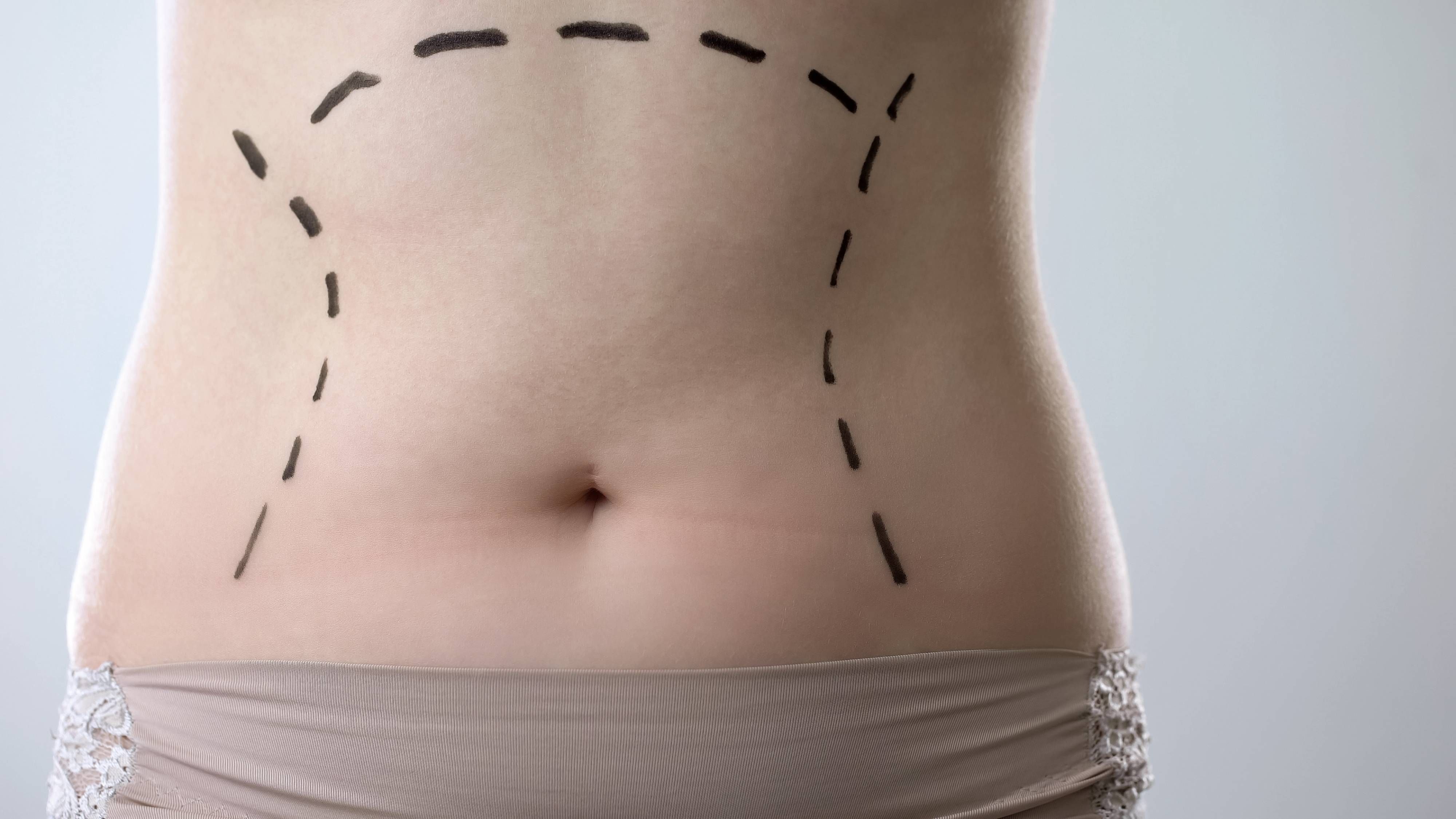 Are You a Good Candidate for a Tummy Tuck?