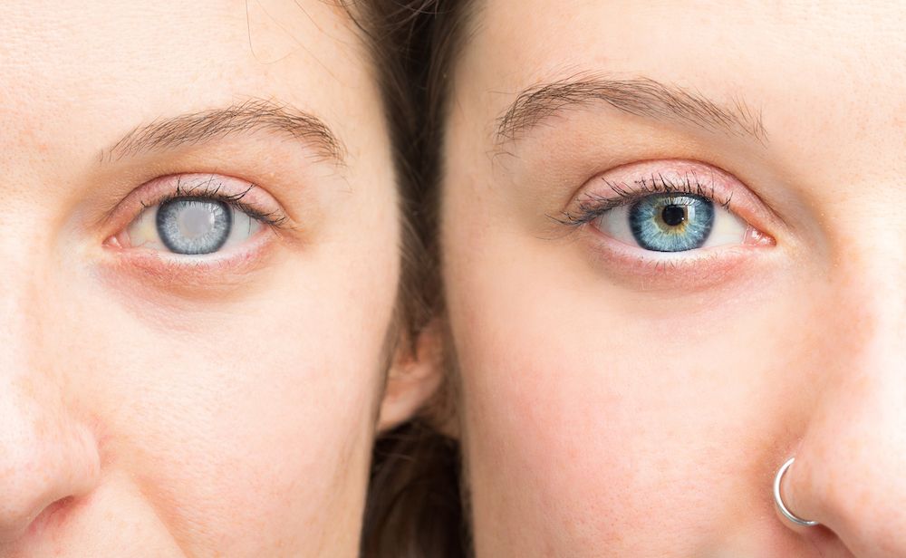 Are Cataracts Preventable?